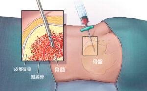 Anemia